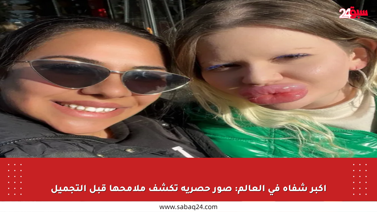 أكبر شفاه في العالم: صور حصرية تكشف ملامحها قبل التجميل
